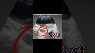 Bulky Uterus  Retroverted Uterus  Ovary Cyst  Simple Cyst on Ultrasound [upl. by Tennaj]