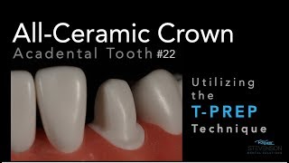 Canine AllCeramic Crown Prep on Acadental 22  Utilizing TPrep Technique [upl. by Herson]