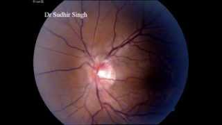 Central Retinal Vein Venous Pulsation On Optic Disc By Dr Sudhir Singh [upl. by Ltihcox427]