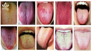 What Your Tongue Has to Say About Your Health [upl. by Shatzer]