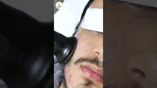 Acne Scar Removal Procedure for Flawless Skin at Care Well Medical Centre [upl. by Egduj415]