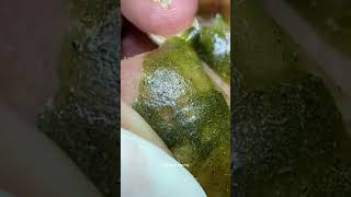 Blackheads Removal  Acne Treatment and Very Satisfying Satisfying Pimple pop blackheads [upl. by Renita]