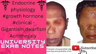 Growth hormone clinicalgigantismacromegalydwarfismmedicoscontent3135 [upl. by Burley]