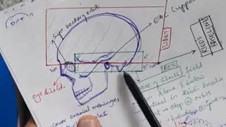 Prophylactic cranial irradiation Craniospinal irradiation German helmet technique PCI CSI WBRT [upl. by Aila739]