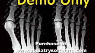 Foot Surgical Animations Part 1 [upl. by Onitselec]