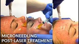 Microneedling PostLaser Treatment with Dr Jason Emer  Live [upl. by Conlin]