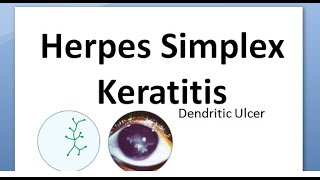 Ophthalmology 116 Herpes Simplex Keratitis Virus Cornea Dendritic HSV Wessley NeuroTrophic Disciform [upl. by Lladnik]