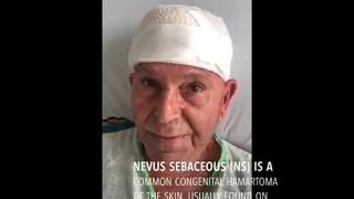 Nevus sebaceous basal cell carcinoma  Cyprus Facial Surgery [upl. by Ogdon412]