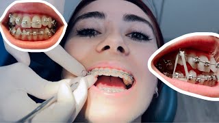 Full BRACES appointment Update [upl. by Marolda]