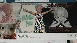 Adalia Rose Austinite social media star with rare genetic condition dies at 15 [upl. by Massimo121]