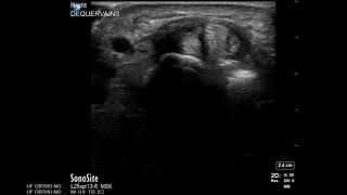 Wrist Ultrasound De Quervains Tenosynovitis Corticosteroid Injection [upl. by Eca693]