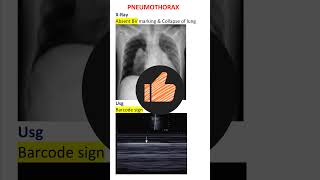 Pneumothorax Diagnosis Xray amp Usg Pearls NEET PG INICET [upl. by Chatterjee]