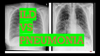 Chest Xray interstitial lung disease vs PneumoniaTypes of opacities in lungs [upl. by Breskin]