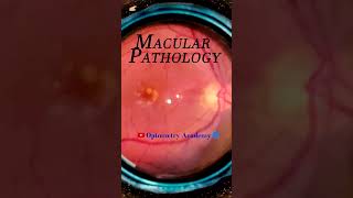 Macular Pathology  Smartphone Fundus Videography  Fundus Photography  Short Video 55 [upl. by Ulphiah]