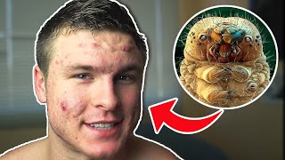 These Live On Your Face amp Cause Acne DEMODEX MITES [upl. by Ayomat91]