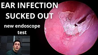 Ear Infection Sucked Out New Endoscope Test [upl. by Serena339]