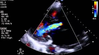 Mitral regurgitation pathophysiology [upl. by Anitsyrhk]