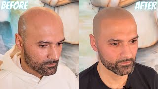 INSIDE LOOK Crazy Scalp Micropigmentation Result [upl. by Yl]