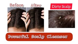 DIY Scalp Scrub Scalp cleanser for flaky Scalp [upl. by Stacia]