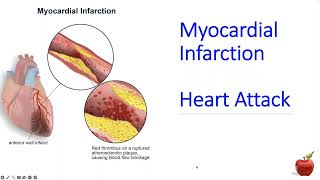 ICD 10 CM coding for a Heart Attack STEMI vs NSTEMI for Beginners [upl. by Airelav]