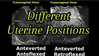 Uterine Positions In Ultrasound  AntevertedRetroverted  AnteflexedRetroflexed Uterus [upl. by Etsirk26]