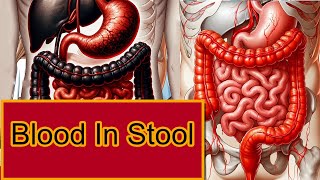 Blood In Stool Melena Vs Hematochezia [upl. by Hunsinger]