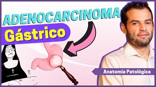 Anatomía Patológica  Carcinoma gástrico [upl. by Htabmas]