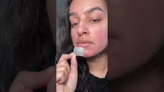 Satisfying Acne Patch Removal acneproneskin acnecommunity pimplepopper [upl. by Spence931]