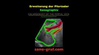 Sonographie  Erweiterung der Pfortader [upl. by Conant]