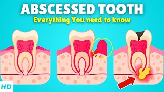 Abscessed Tooth – Causes Signs and Symptoms Diagnosis amp Treatment [upl. by Cristionna]