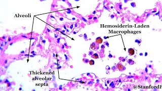 Hemosiderin Laden Macrophages  Definition Causes Function Detection Clinical significance [upl. by Ellivnarg26]