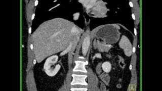 Abdomen Liver Hemangioma of the Liver6 of 8 [upl. by Warfeld15]