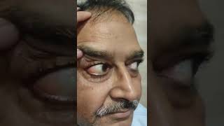 conjunctival cyst conjunctiva eyeball kripanandkumar neet ophthalmology [upl. by Resor]