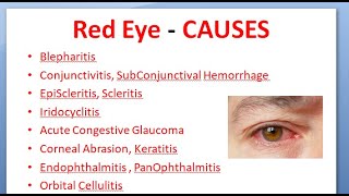 Ophthalmology 167 Acute Red Eye Differential Diagnosis causes Conjunctivitis Uveitis Glaucoma [upl. by Atoel969]