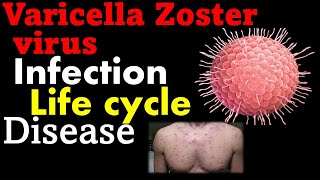 Varicella zoster virus pathogenesis  chickenpox virus [upl. by Cheslie]