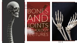 BONES AND JOINTS PATHOLOGY lecture 9 CHONDROMA OSTEOCHONDROMA AND CHONDROSARCOMA all imp points [upl. by Polivy]