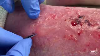 Dermatologist Popping Blisters  CONTOUR DERMATOLOGY [upl. by Rolan861]