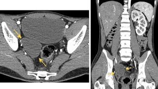 Short Case Discussion Zinner Syndrome [upl. by Dowling]