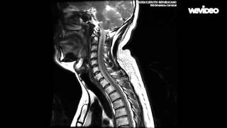 Resonancia Dinámica Columna Cervical [upl. by Merce]