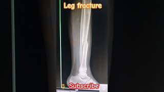 Left Leg 🦵 AP lateral view Xray shorts viral medical student trending craft me [upl. by Wendie]