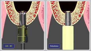 HiOssen Demonstration CASKit compared to Osteotome [upl. by Icak]