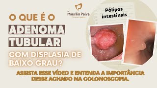 Colonoscopia com adenoma tubular com displasia de baixo grau  é grave [upl. by Alfeus]