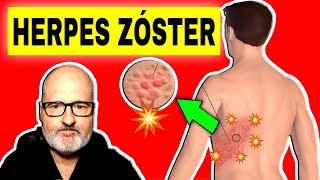 HERPES ZOSTER Culebrilla Síntomas Causas y Tratamiento 🔴 [upl. by Laval]