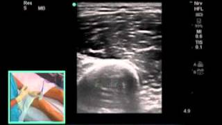 How to Ultrasound Guided Saphenous Nerve Block Scanning Technique [upl. by Hourigan]