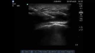 trochanteric bursitis injection [upl. by Anohs]