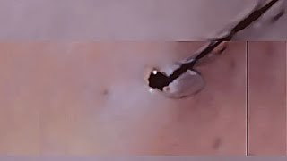 Removal of ingrown hair [upl. by Anawek]