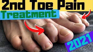 2nd Toe Capsulitis Claw Toe amp Hammer Toe RELIEF Taping amp Treatment [upl. by Sondra453]