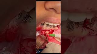 Surgery for impacted mandibular canine traction [upl. by Crystal63]