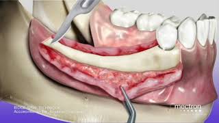 Mectron Piezosurgery  수술의 퀄리티를 높이는 필수장비 [upl. by Zysk811]