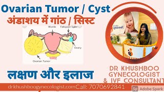 Ovarian Cyst  Ovarian Tumor Symptoms ampTreatment in Hindi  Dr Khushboo Gynecologist in Patna [upl. by Nonohcle]